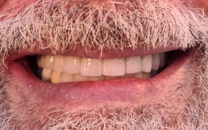 dinti refacuti la lll dental