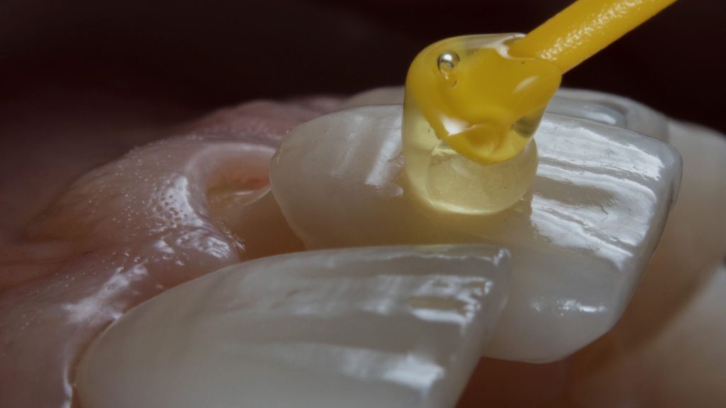 aplicarea fatetelor dentare