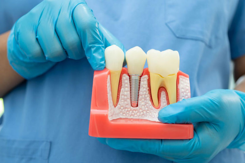 cafeaua dupa implant dentar