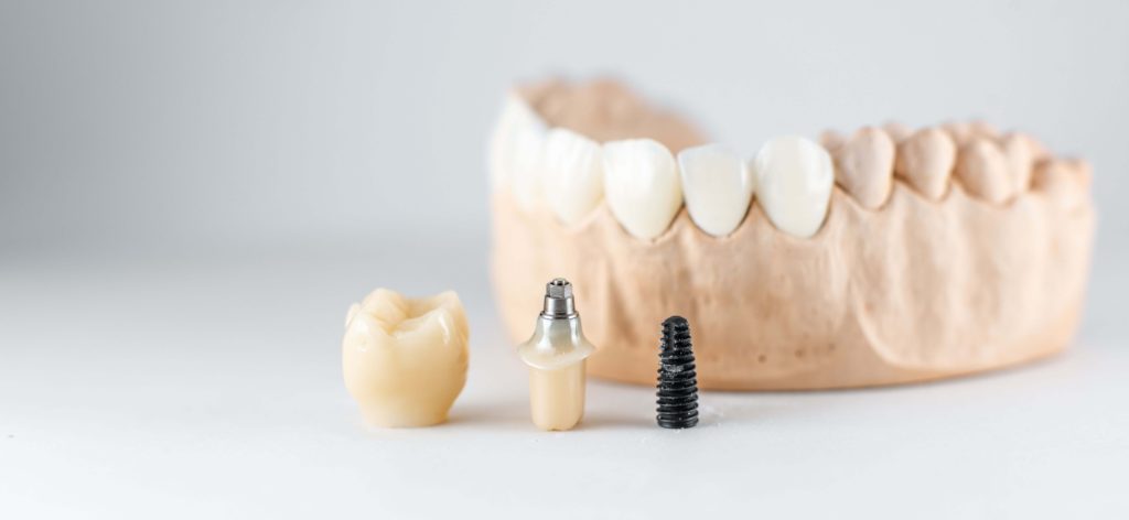 cand nu poti pune implant dentar