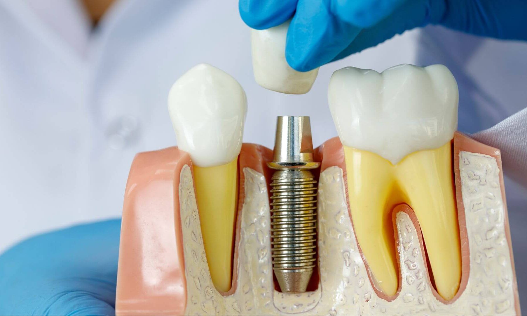 coroana dentara pe implant