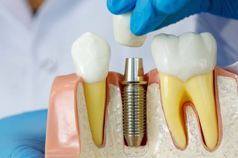 coroana dentara pe implant
