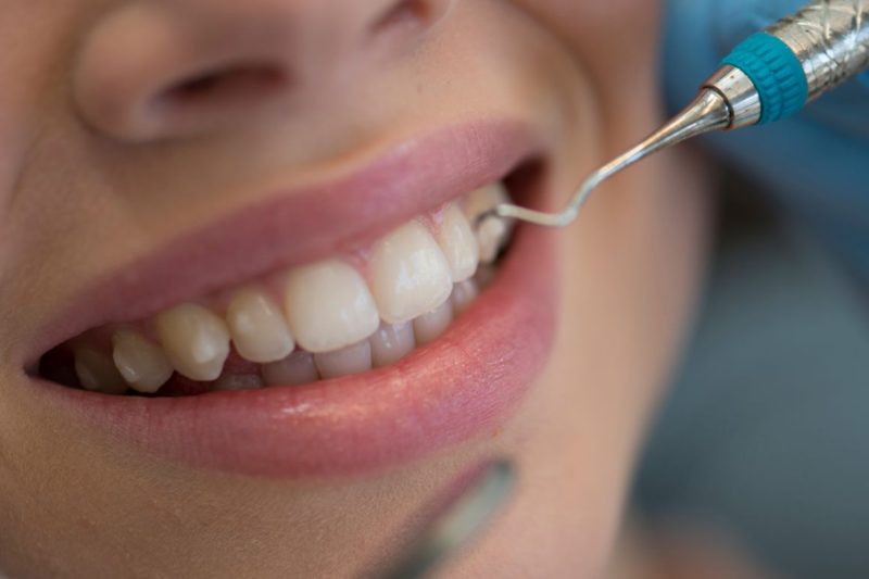 demineralizare dinti