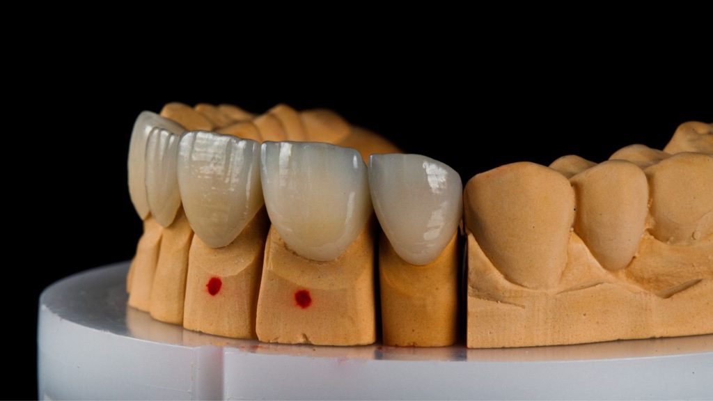 dezavantaje fatete dentare