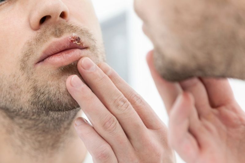 herpes bucal