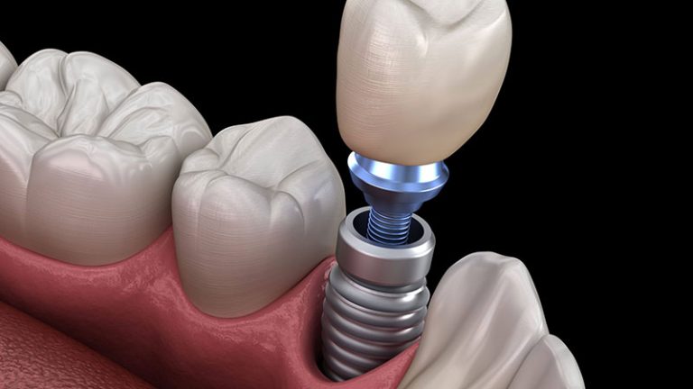 Implant dentar