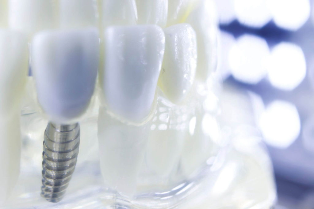 implant dentar titan