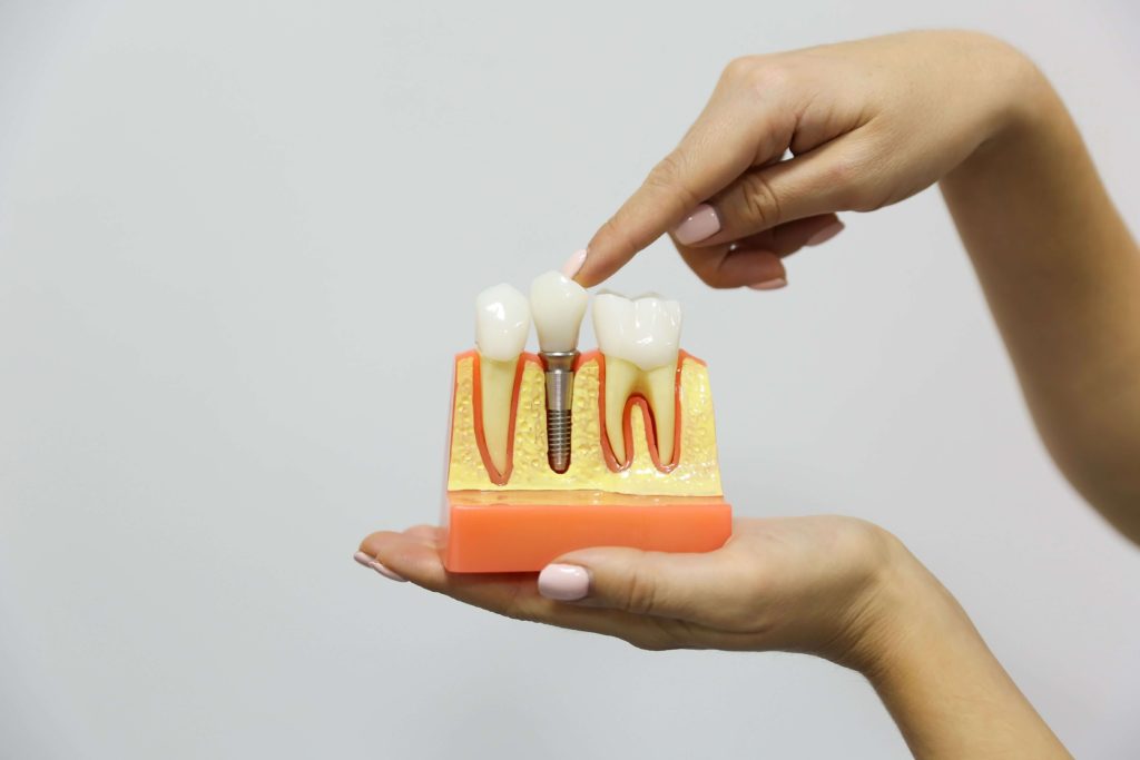 implant si coroana dentara