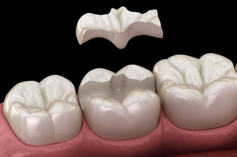 dinti incrustatii dentare