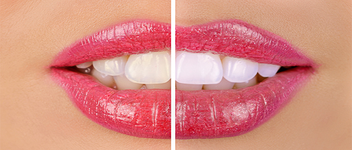 tratament albire dinti