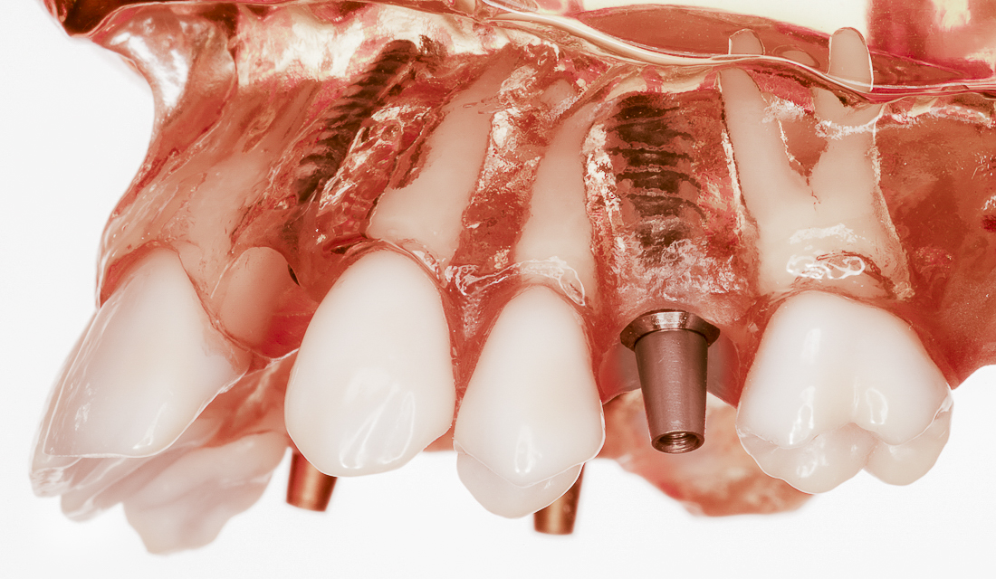 macheta implant dentar