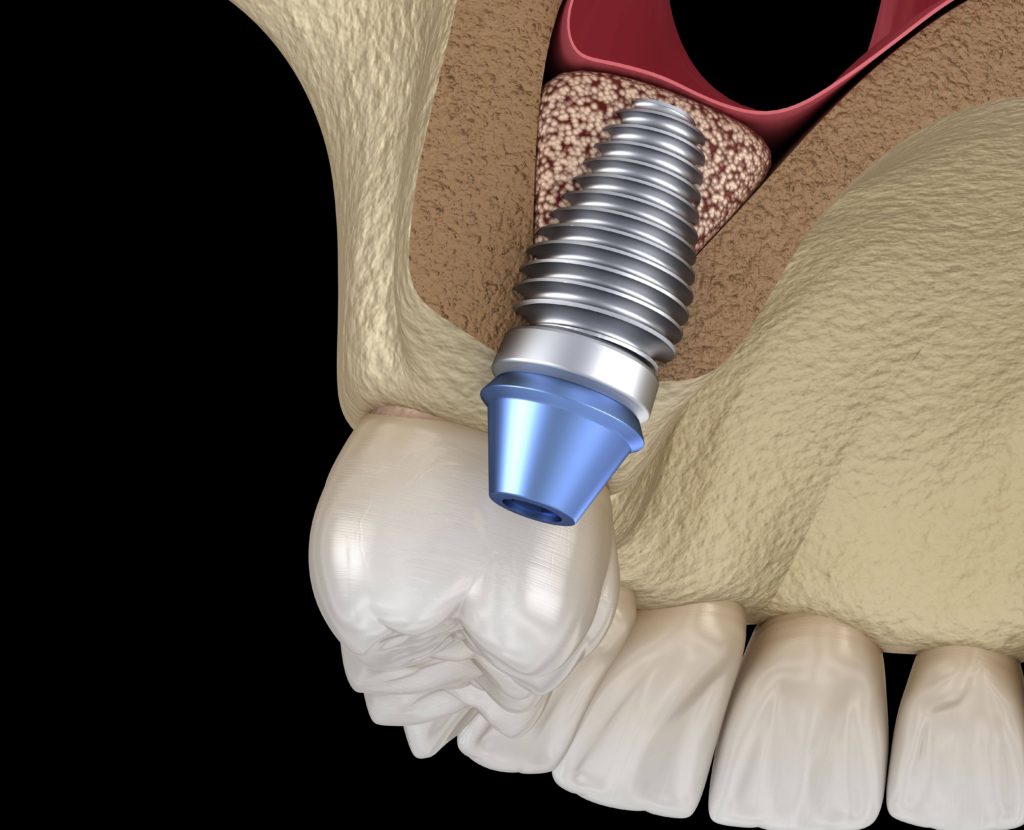 procedura sinus lift