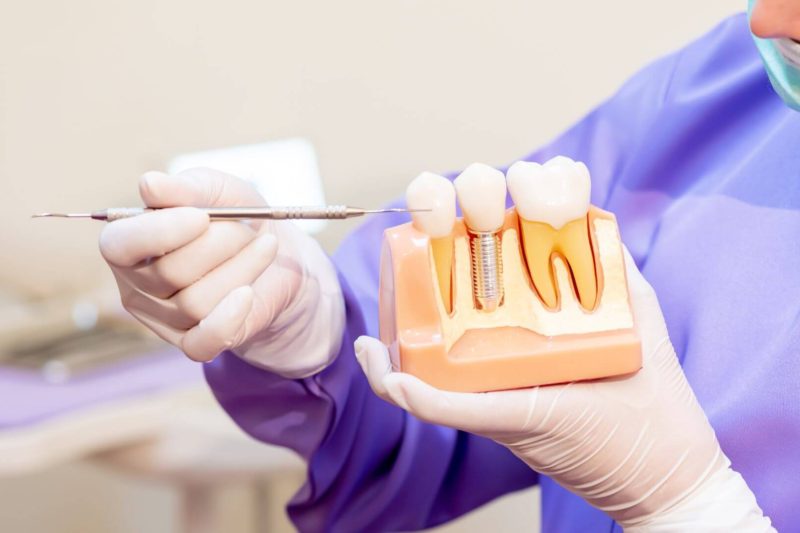 recuperarea dupa implantul dentar