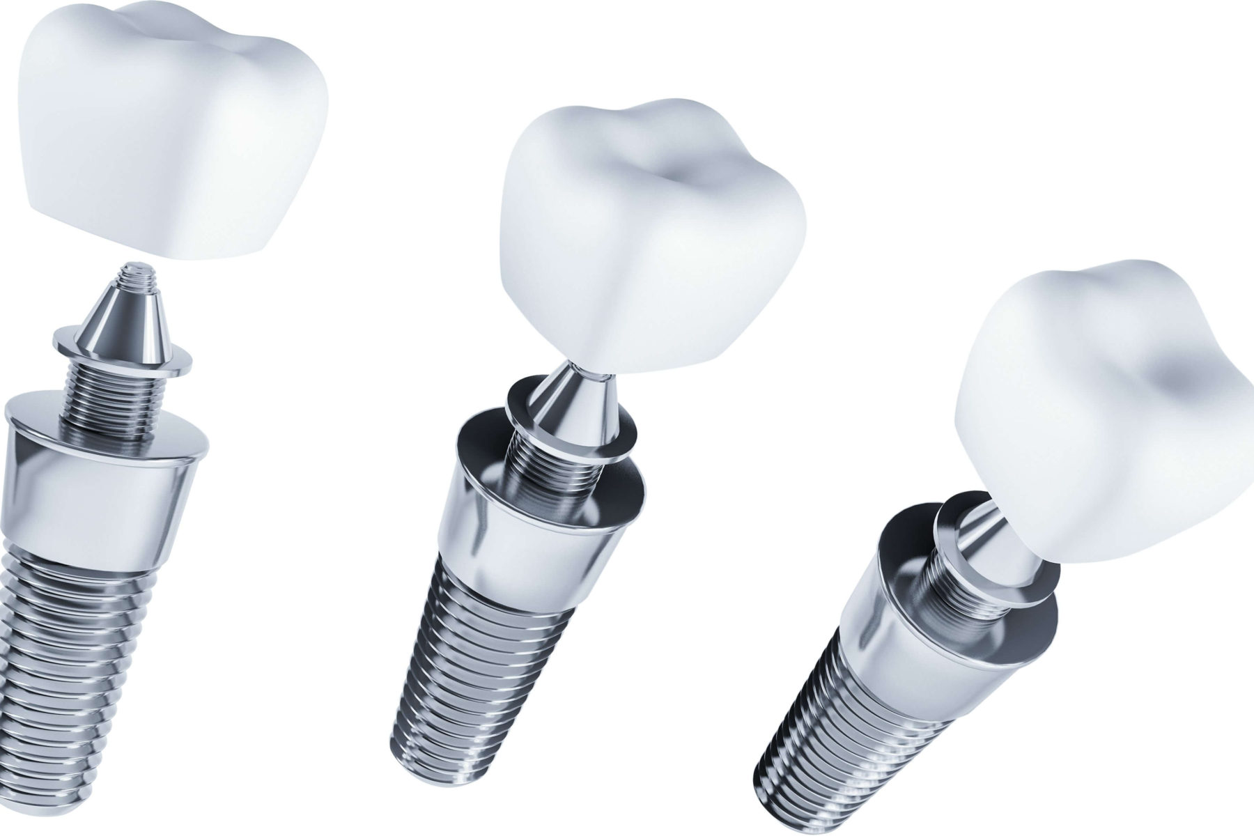 tipuri de implanturi dentare