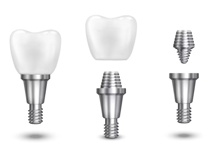 Pretul unui implant dentar