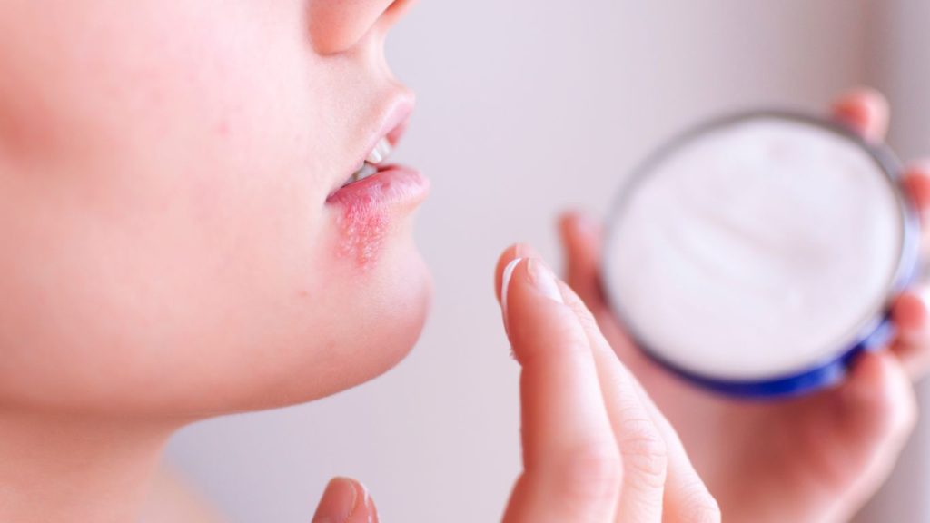 tratament herpes bucal