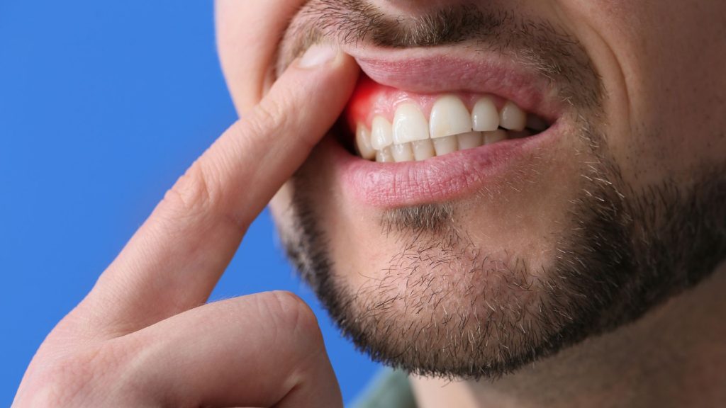 tratament paradontoza avansata