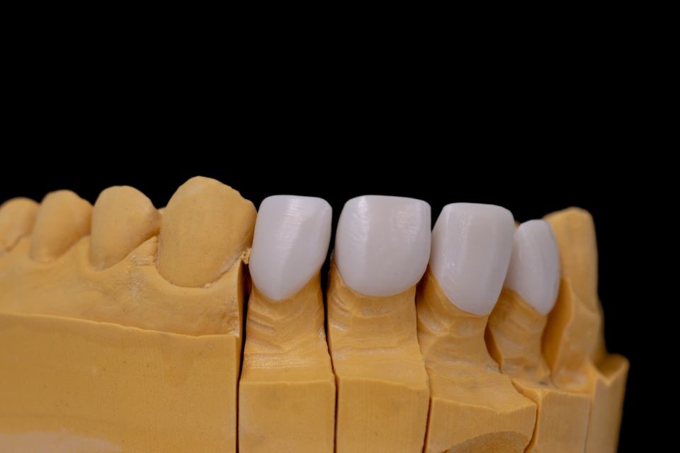 dinti coroane zirconiu